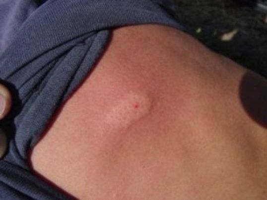 Identifica las picaduras más peligrosas de bichos