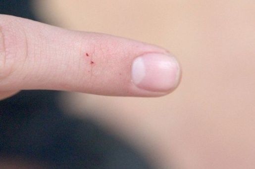 Identifica las picaduras más peligrosas de bichos