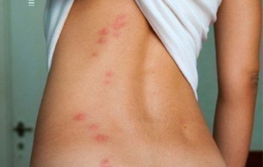 Identifica las picaduras más peligrosas de bichos