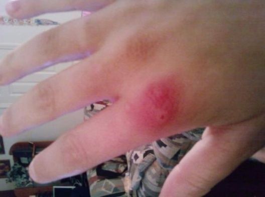 Identifica las picaduras más peligrosas de bichos