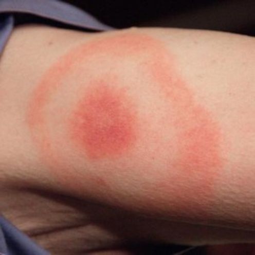 Identifica las picaduras más peligrosas de bichos