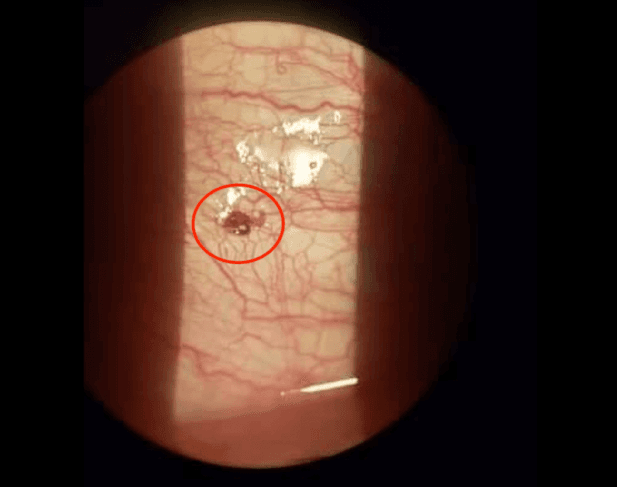 Tenía una garrapata incrustada en el ojo