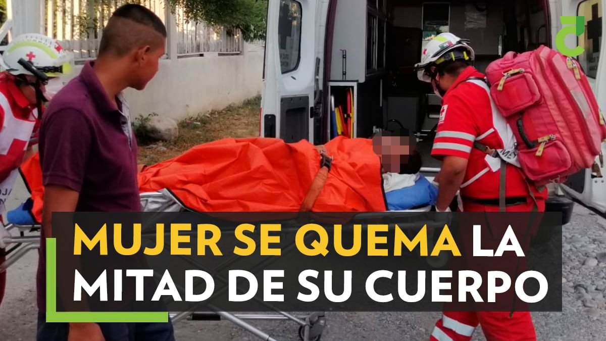 Mujer sufre quemaduras de segundo grado en la mitad de su cuerpo