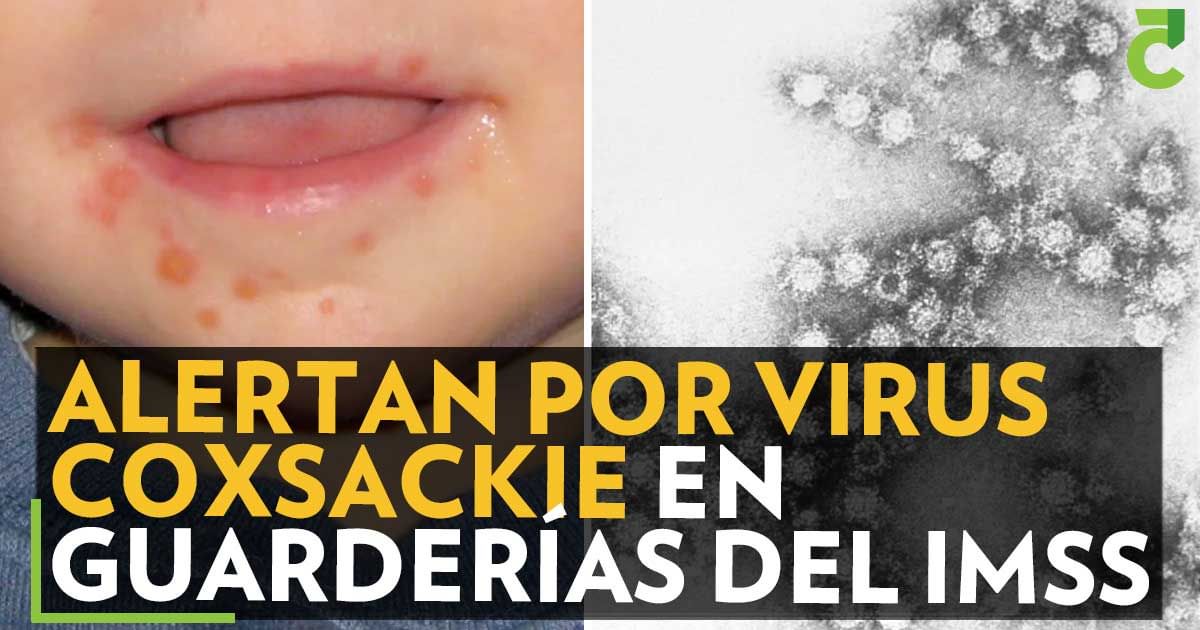 Alertan por virus Coxsackie en guarderías del IMSS